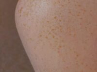 팔에 빨간점 생기는 이유, 예방, 추후 변화 및 치료 방법