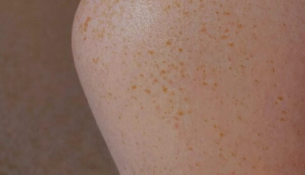 팔에 빨간점 생기는 이유, 예방, 추후 변화 및 치료 방법