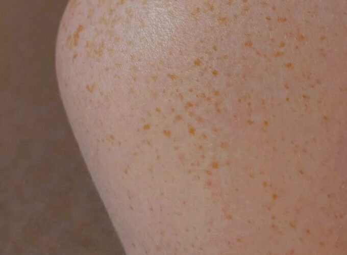 팔에 빨간점 생기는 이유, 예방, 추후 변화 및 치료 방법