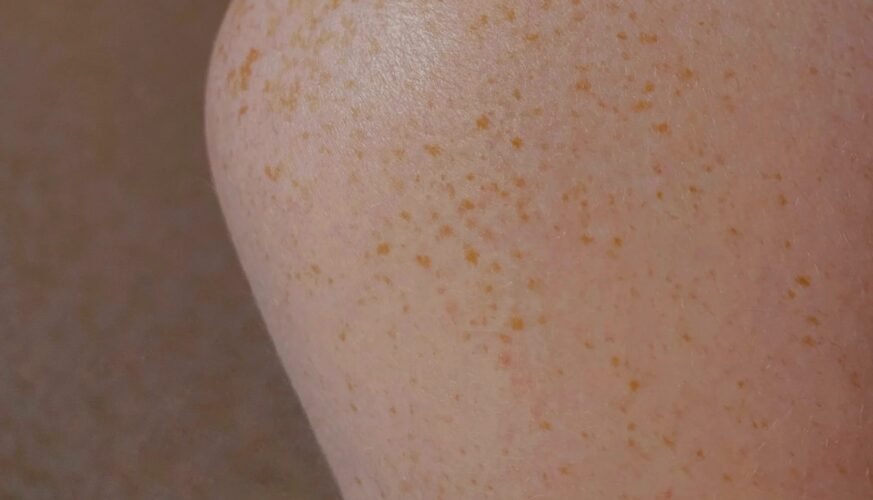 팔에 빨간점 생기는 이유, 예방, 추후 변화 및 치료 방법 1 팔에 빨간점 생기는 이유, 예방, 추후 변화 및 치료 방법