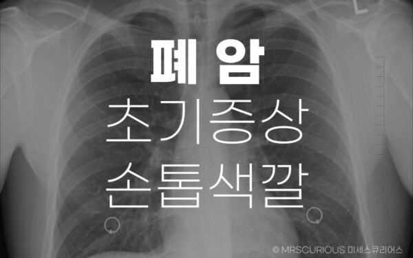 폐암 초기증상 손톱색깔