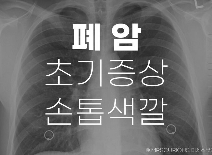 폐암 초기증상 손톱색깔