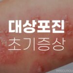 대상포진 초기증상, 후유증 및 회복기간 자세히 알아보기 10 대상포진 초기증상 후유증
