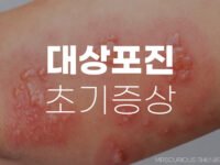 대상포진 초기증상 후유증