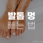 발톱 멍 빼는 법 그리고 생기는 원인과 증상에 대해 알아보기 6 발톱 멍 빼는 법
